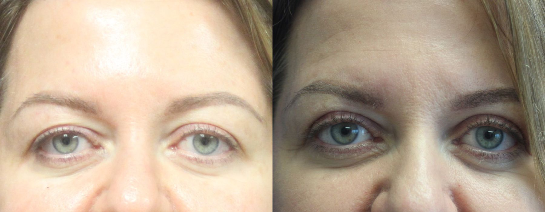 Blepharoplasty Upper Eyelids - Case 15532