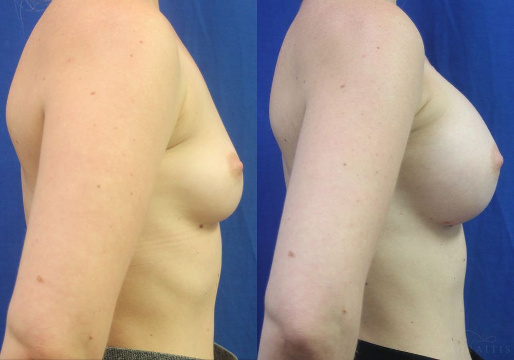 Breast Augmentation - Thumbnail 3