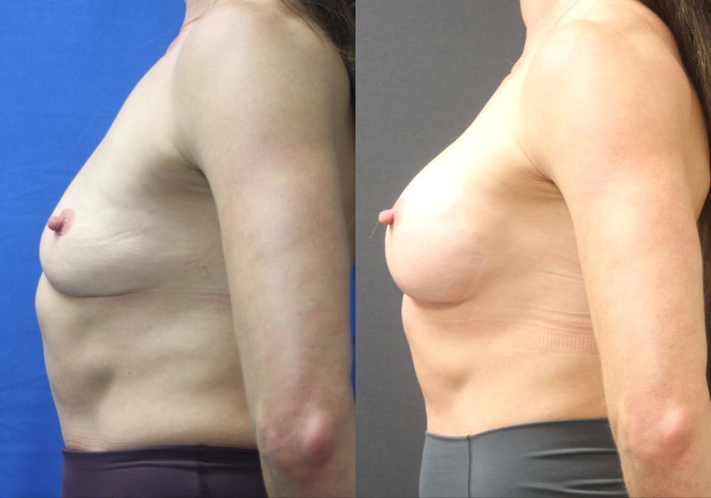 Breast Augmentation - Thumbnail 3