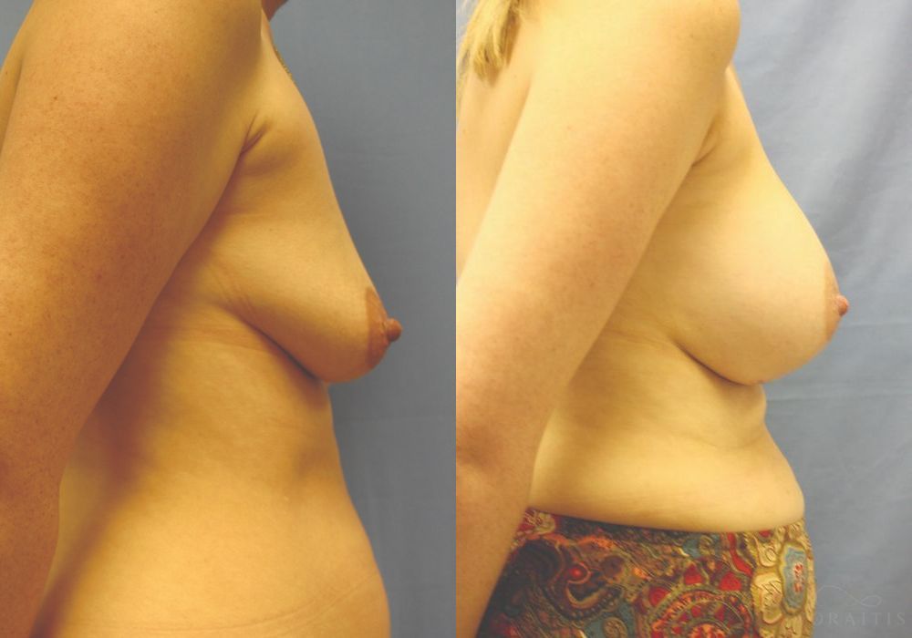 Breast Augmentation - Thumbnail 3