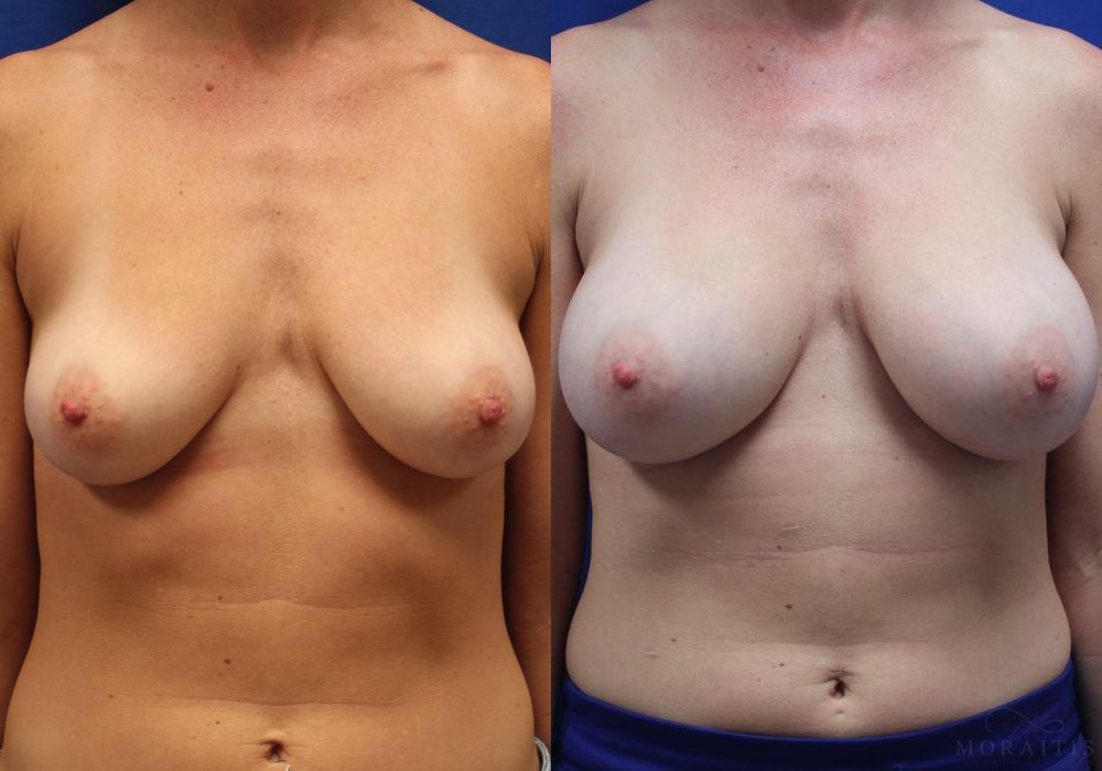 Breast Augmentation - Case 15403