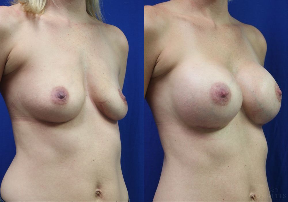 Breast Augmentation - Thumbnail 2