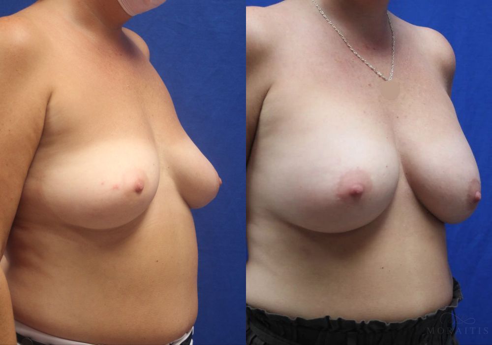 Breast Augmentation - Thumbnail 2
