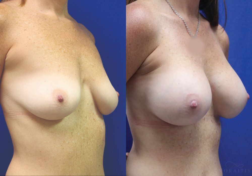 Breast Augmentation - Thumbnail 2