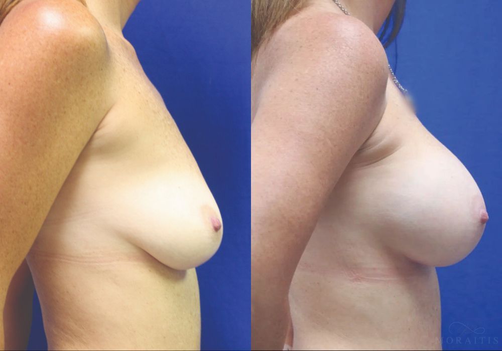 Breast Augmentation - Thumbnail 3