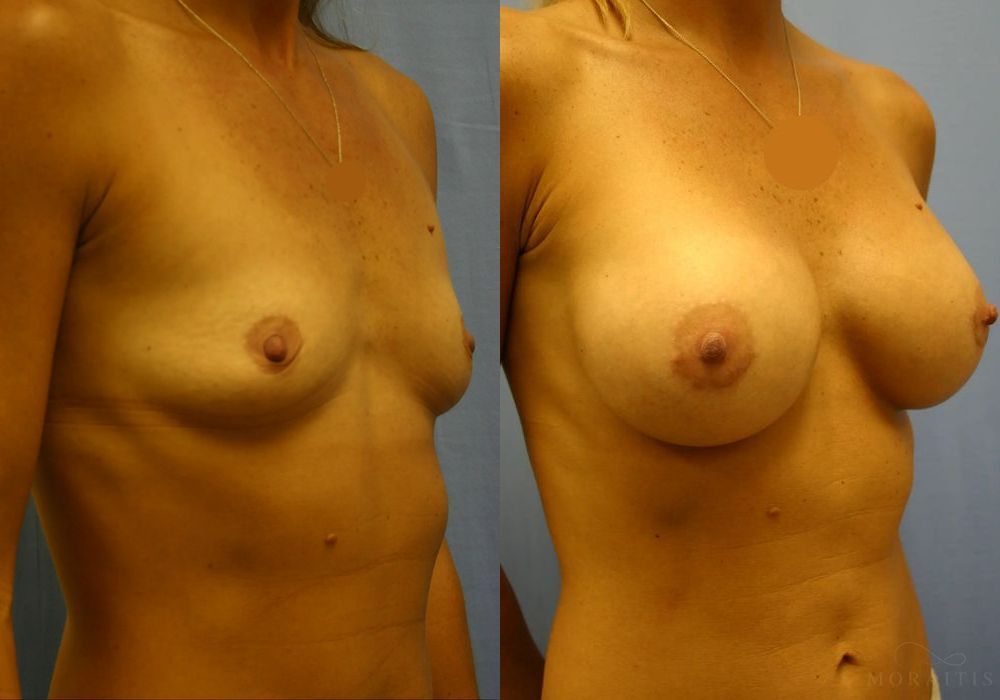 Breast Augmentation - Thumbnail 2