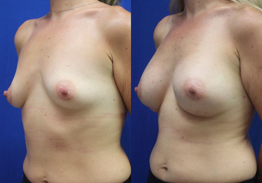 Breast Augmentation - Thumbnail 2