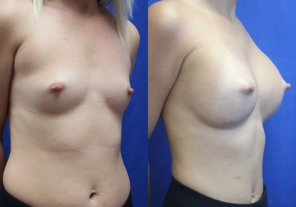 Breast Augmentation - Thumbnail 2