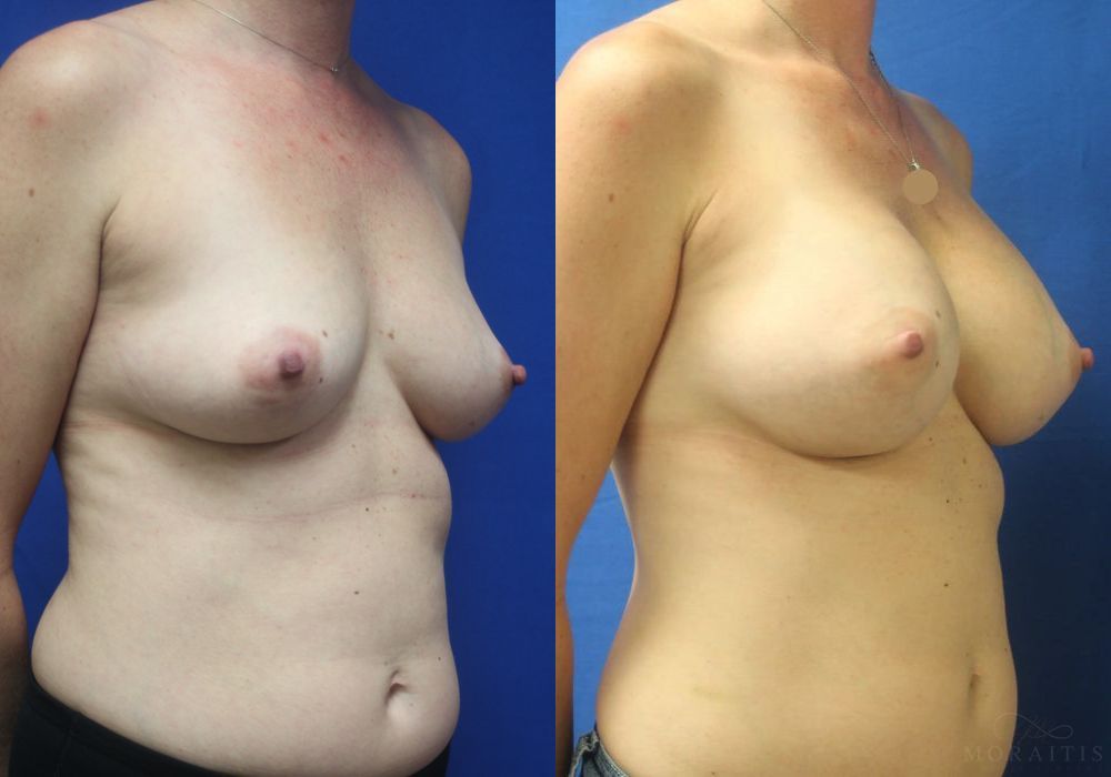Breast Augmentation - Thumbnail 2
