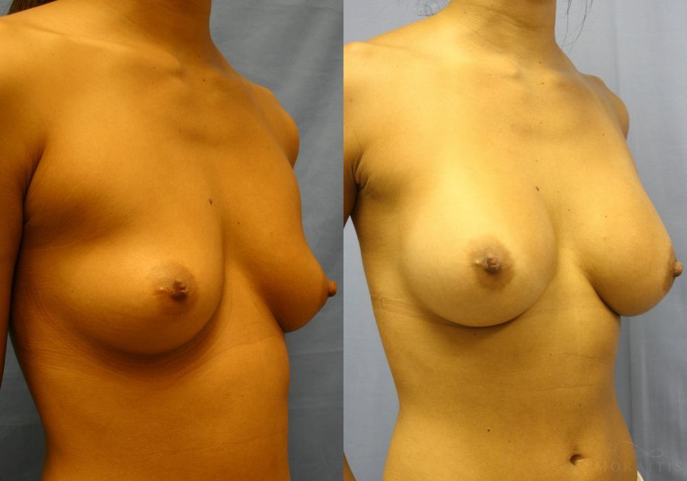 Breast Augmentation - Thumbnail 2