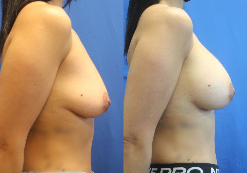 Breast Augmentation - Thumbnail 3