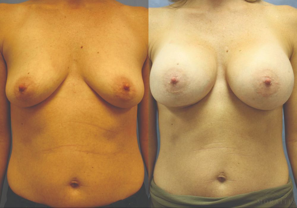 Breast Augmentation - Case 15394