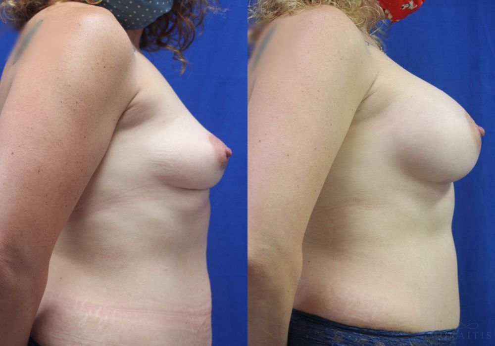 Breast Augmentation - Thumbnail 3