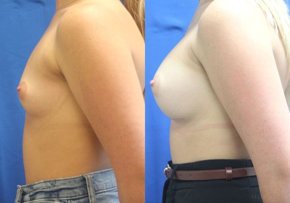 Breast Augmentation - Thumbnail 3