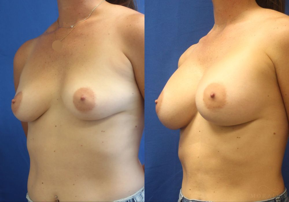 Breast Augmentation - Thumbnail 2