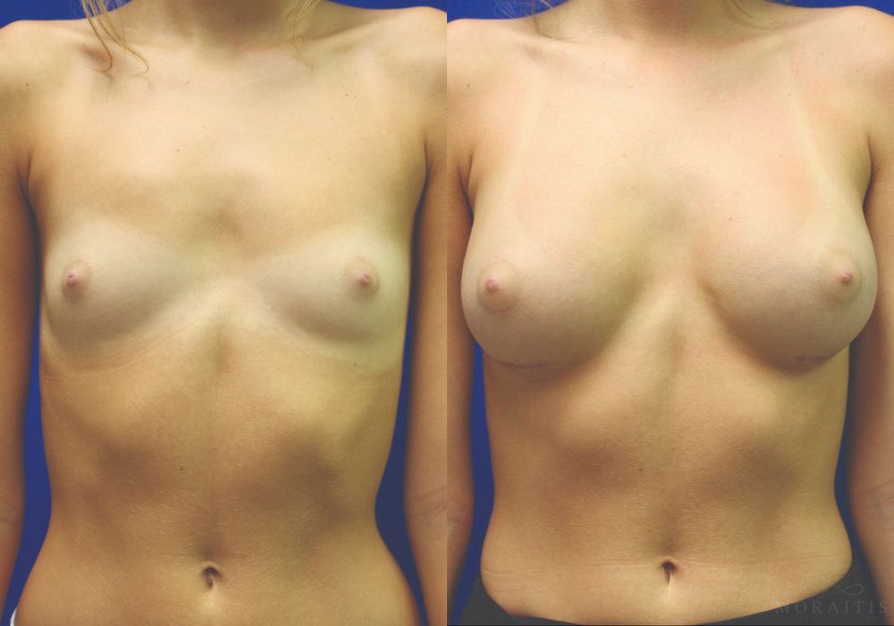 Breast Augmentation - Case 15395