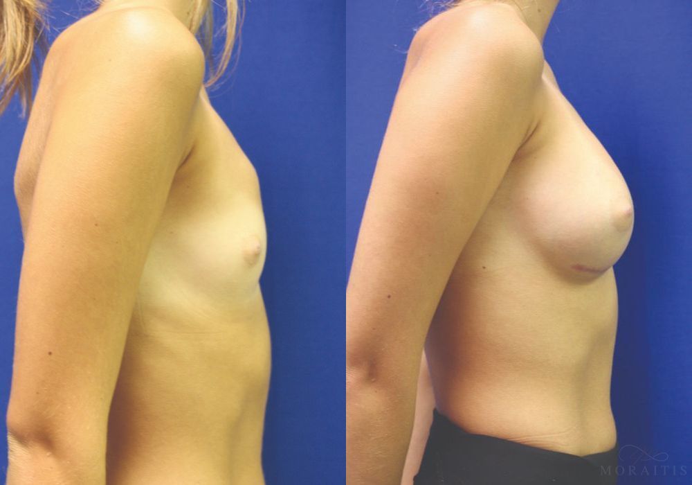 Breast Augmentation - Thumbnail 3