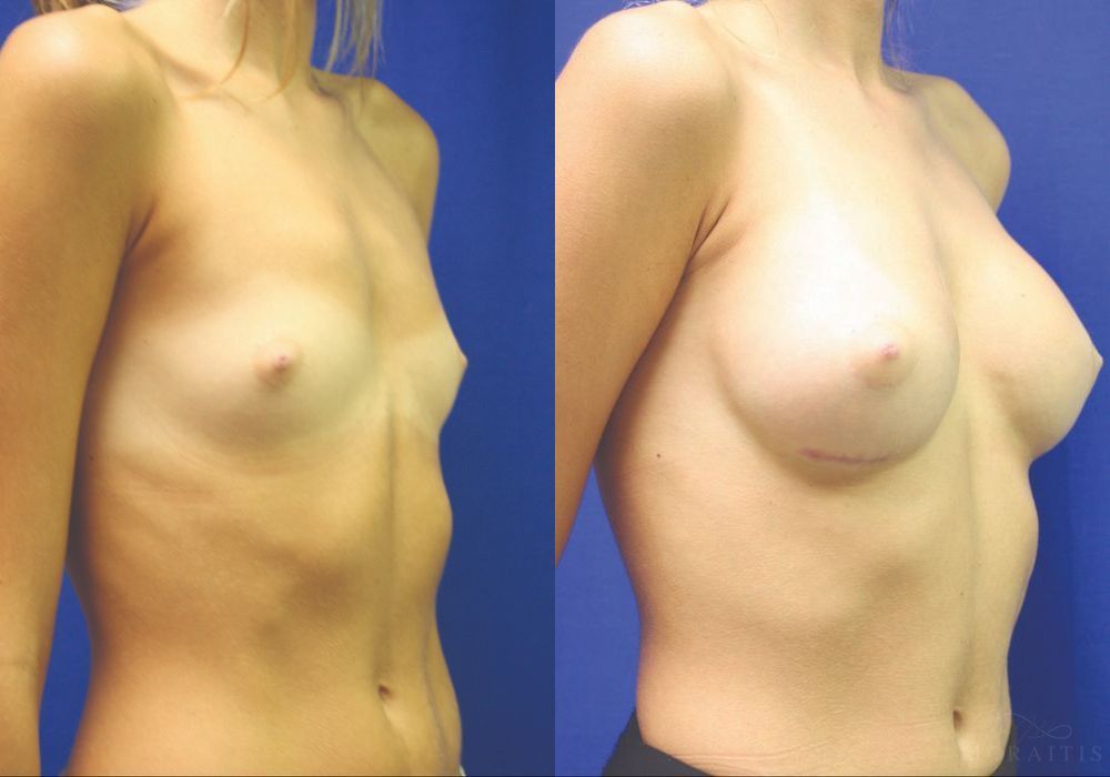Breast Augmentation - Thumbnail 2