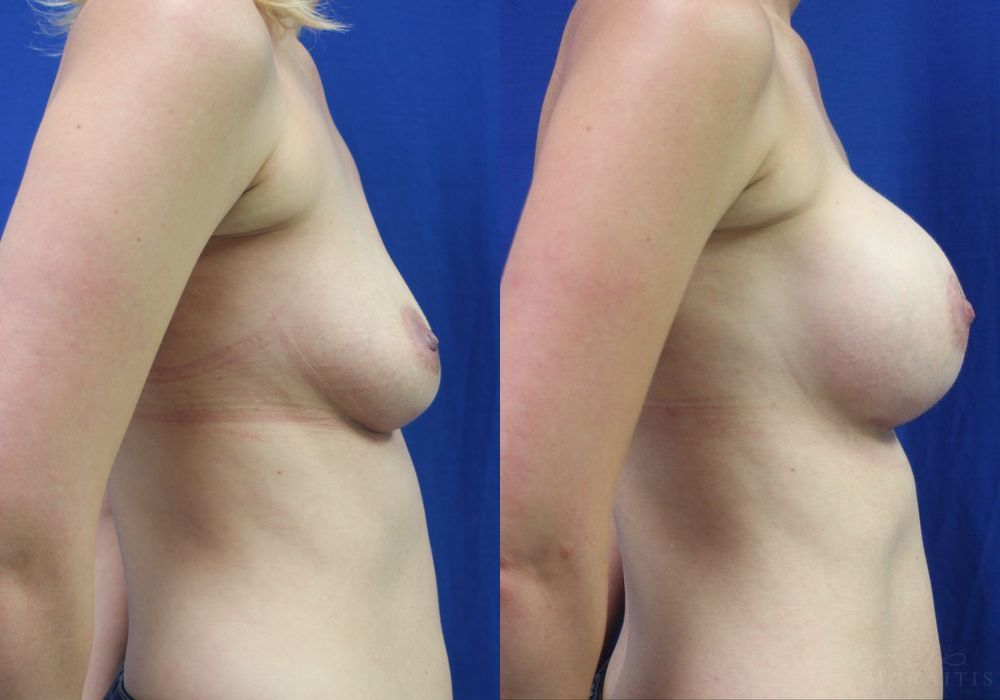 Breast Augmentation - Thumbnail 3