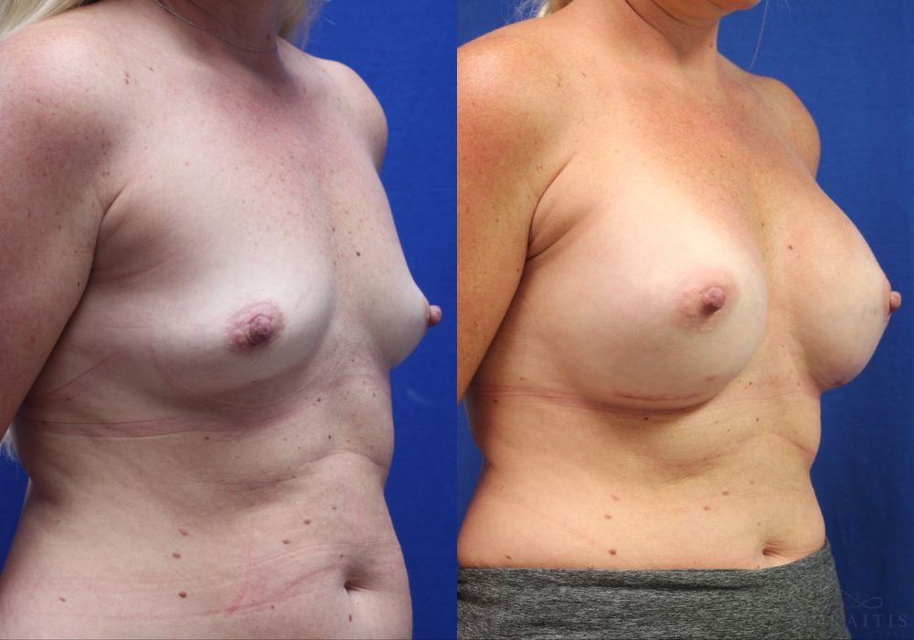 Breast Augmentation - Thumbnail 2