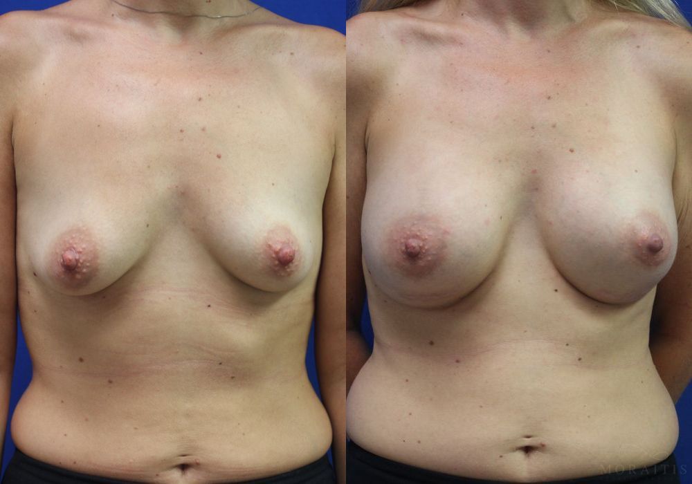 Breast Augmentation - Case 15407