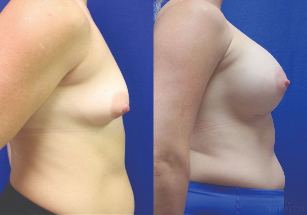 Breast Augmentation - Thumbnail 3