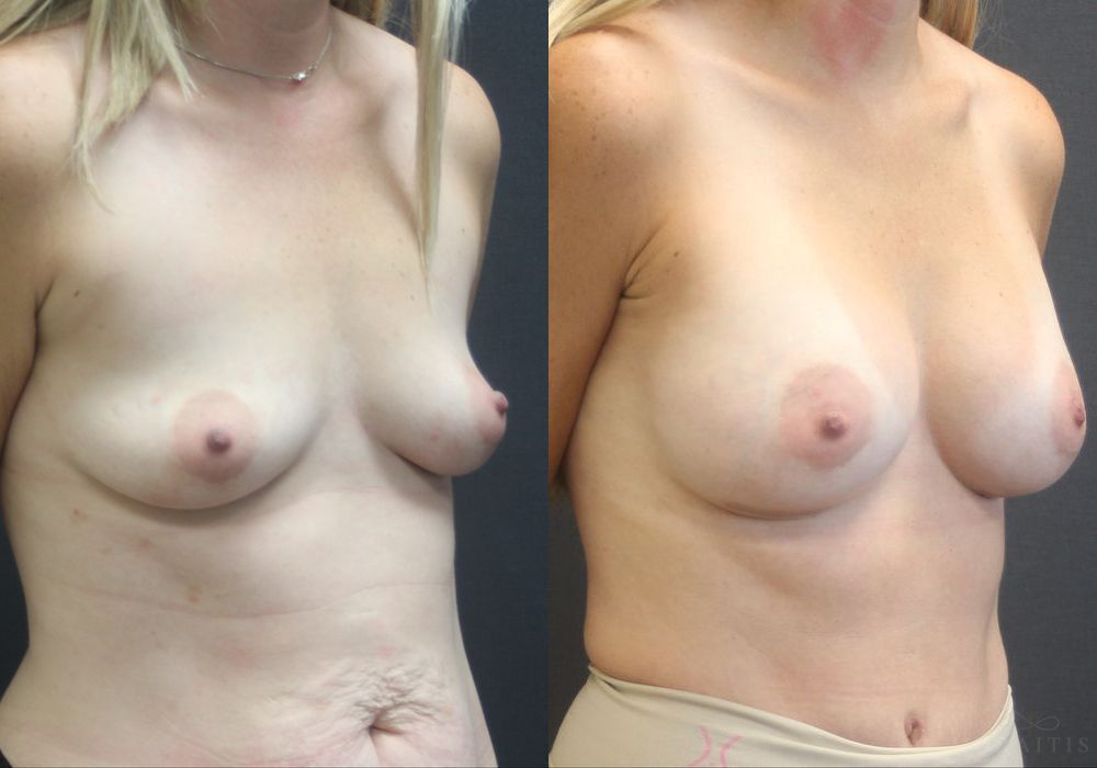 Breast Augmentation - Thumbnail 2