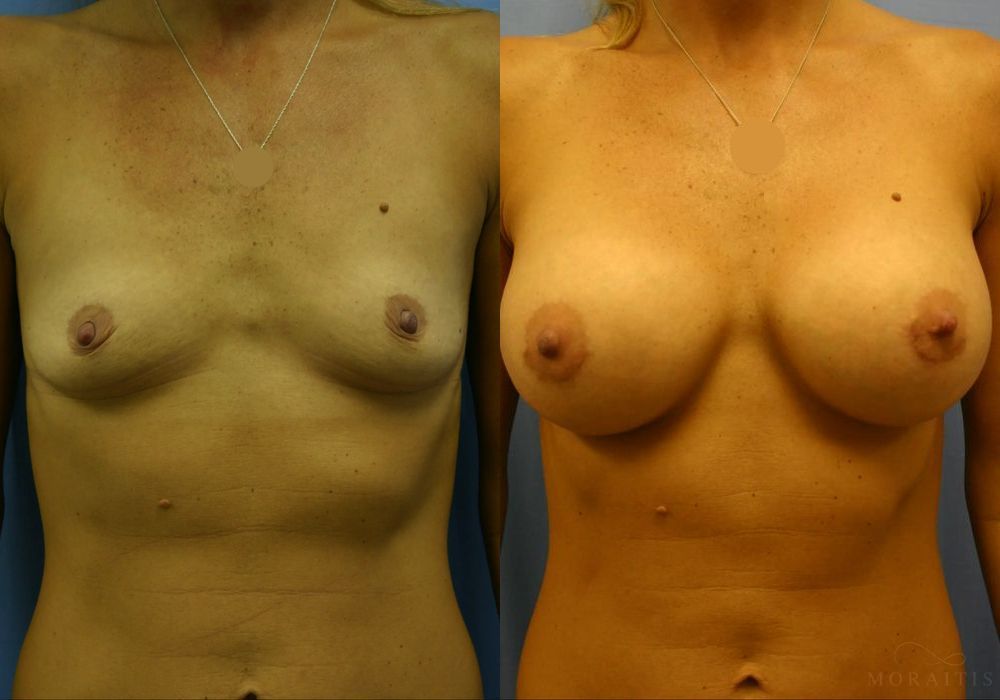 Breast Augmentation - Case 15520