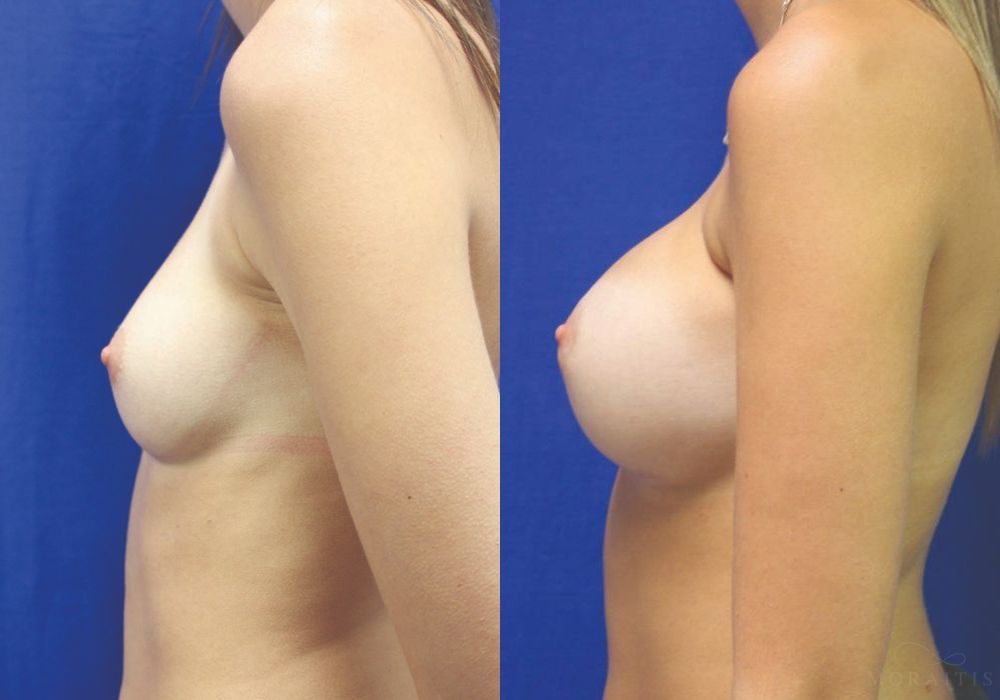 Breast Augmentation - Thumbnail 3