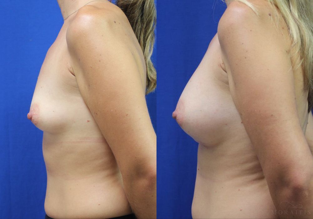 Breast Augmentation - Thumbnail 3