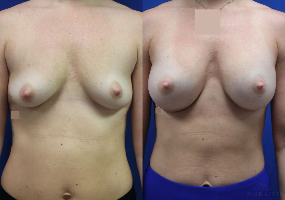 Breast Augmentation - Case 15402
