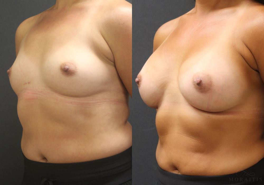 Breast Augmentation - Thumbnail 2