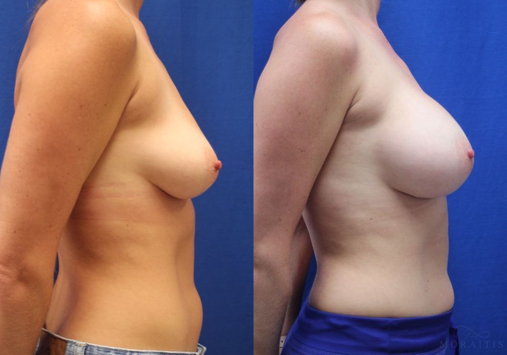 Breast Augmentation - Thumbnail 3