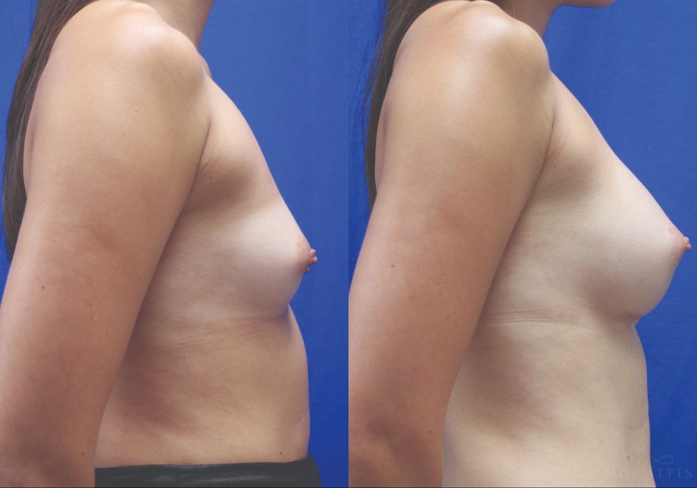 Breast Augmentation - Thumbnail 3