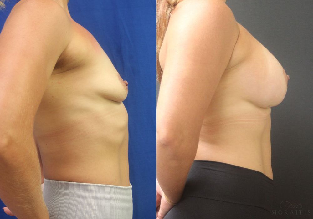 Breast Augmentation - Thumbnail 3