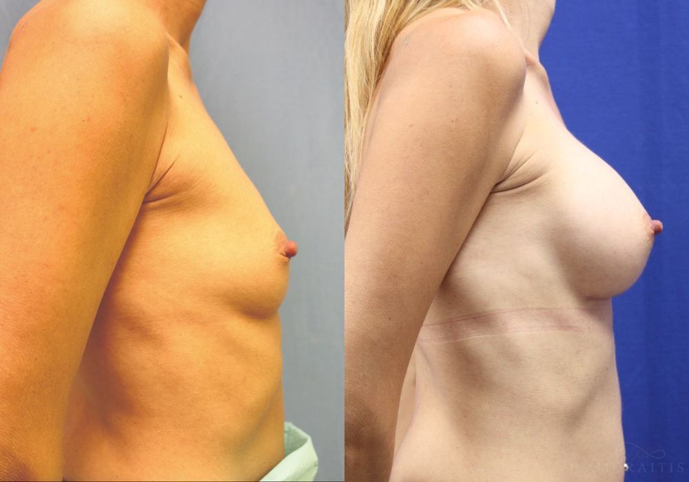 Breast Augmentation - Thumbnail 3