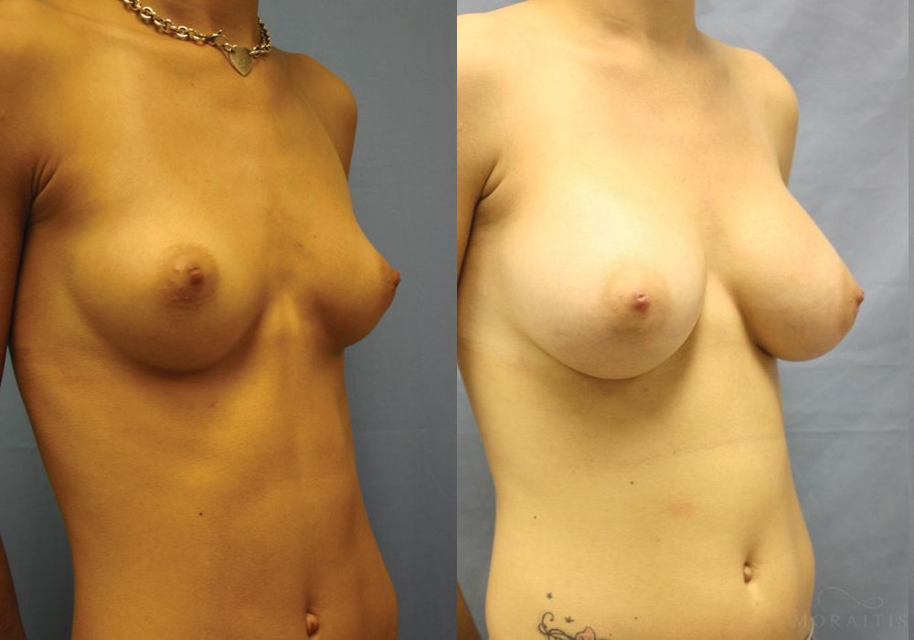 Breast Augmentation - Thumbnail 2