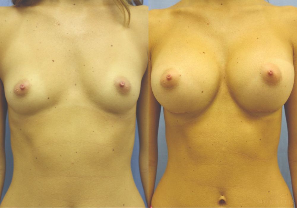 Breast Augmentation - Case 15386