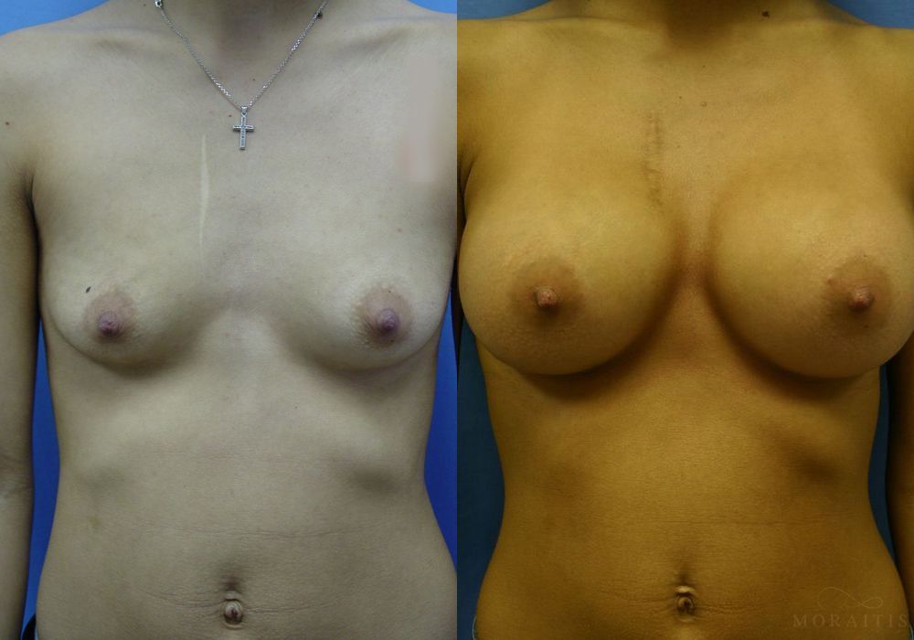 Breast Augmentation - Case 15377