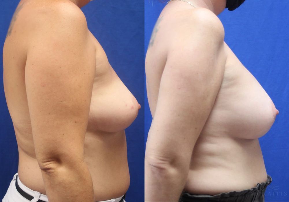 Breast Augmentation - Thumbnail 3