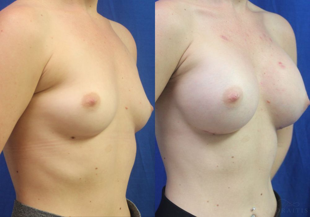 Breast Augmentation - Thumbnail 2