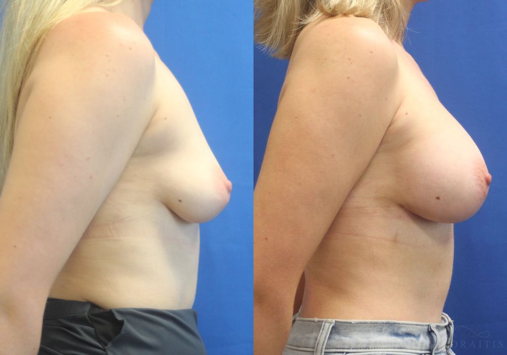 Breast Augmentation - Thumbnail 3