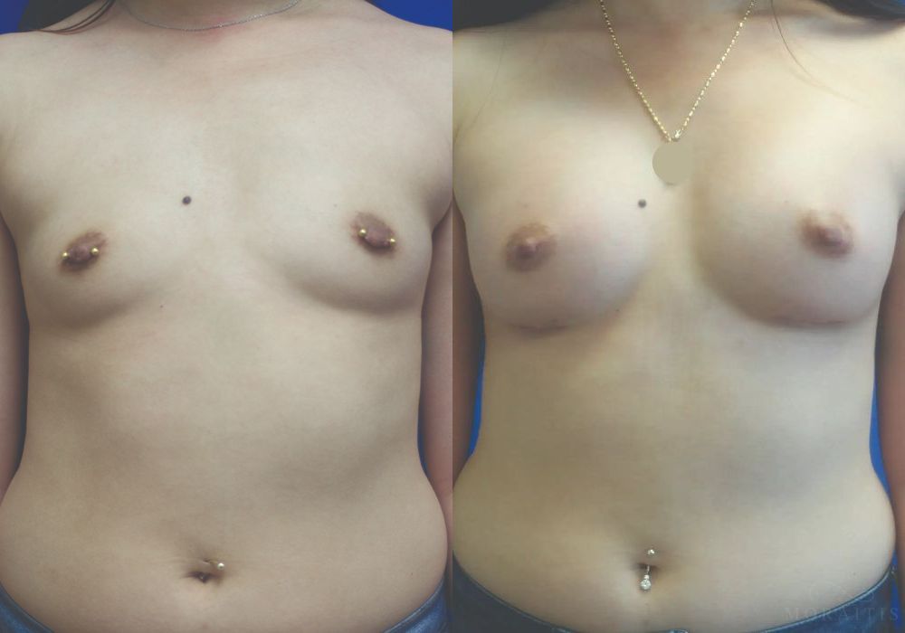Breast Augmentation - Case 15380