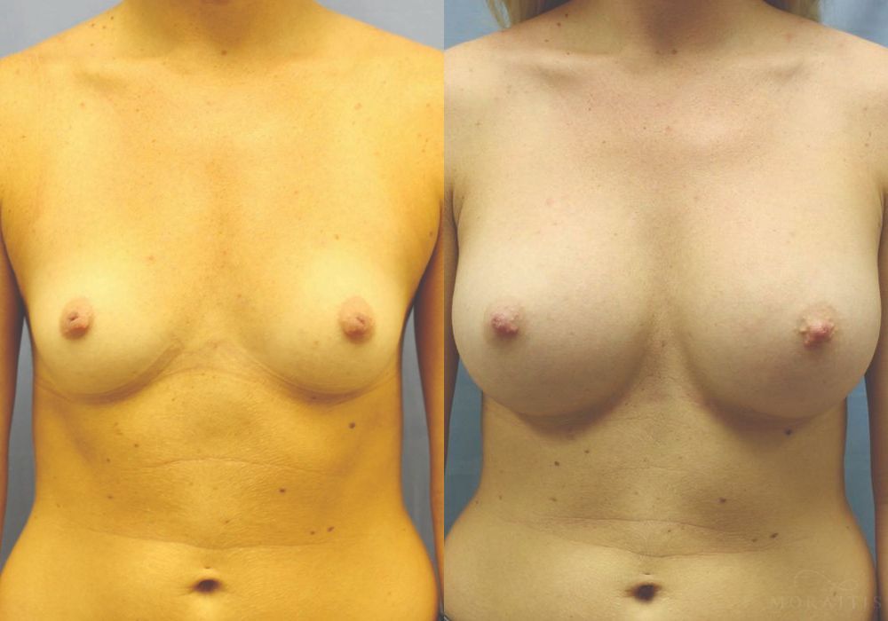 Breast Augmentation - Case 15738