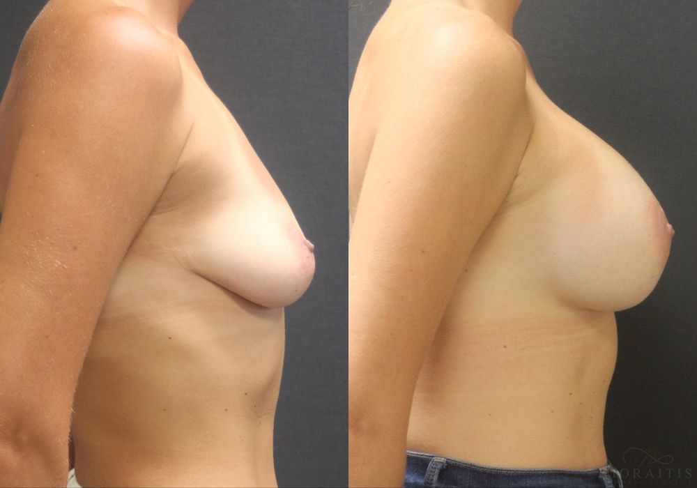 Breast Augmentation - Thumbnail 3