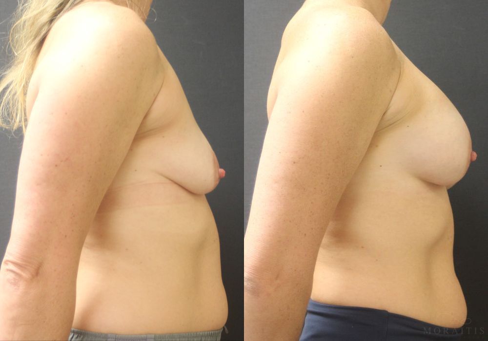 Breast Augmentation - Thumbnail 3
