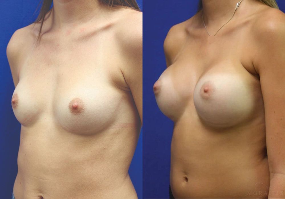 Breast Augmentation - Thumbnail 2