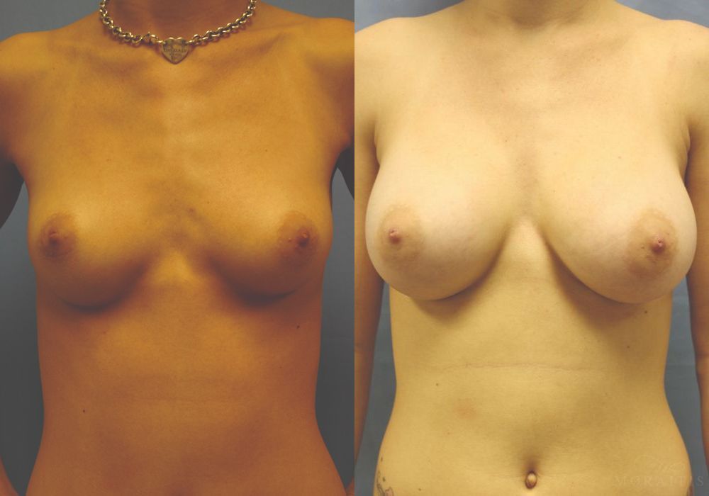 Breast Augmentation - Case 15396