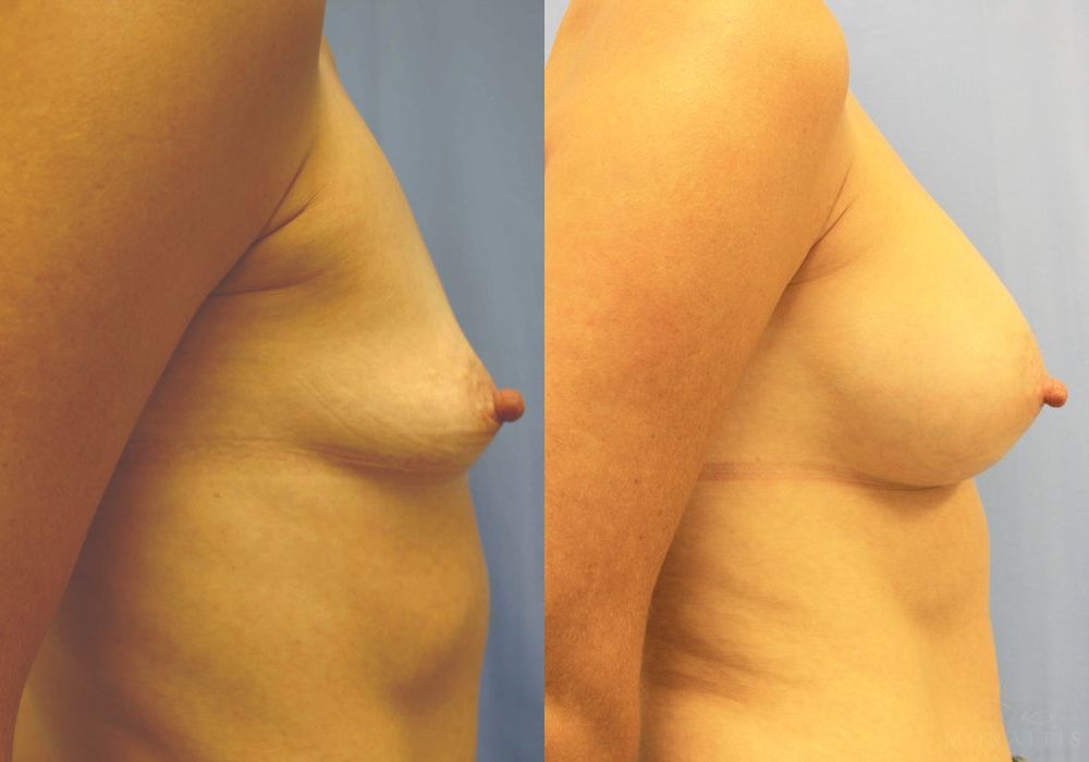 Breast Augmentation - Thumbnail 3