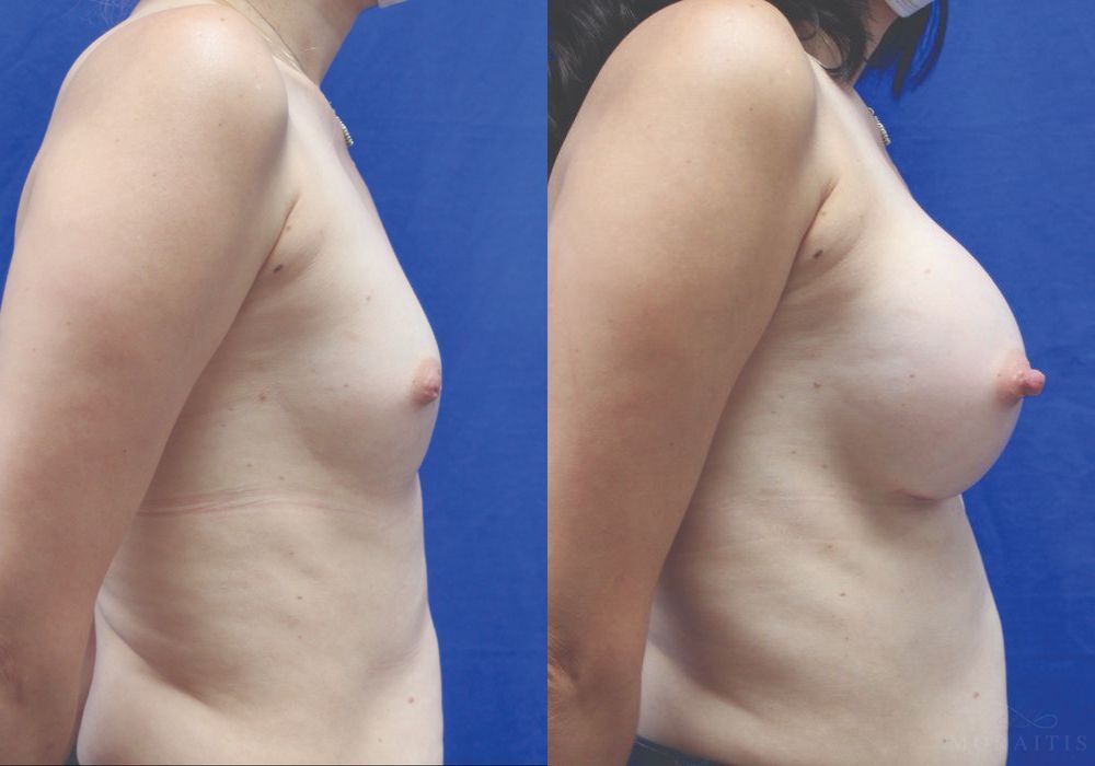 Breast Augmentation - Thumbnail 3